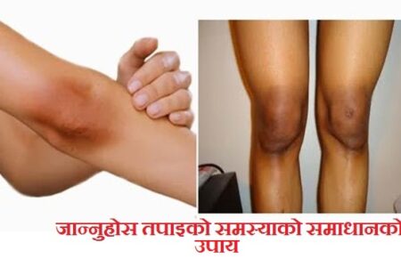 घुँडा तथा कुहिनो कालो भयो नआत्तिनुहोस,तपाइको समस्या समाधान गर्न अपनाउनुहोस् यी घरेलु उपाय